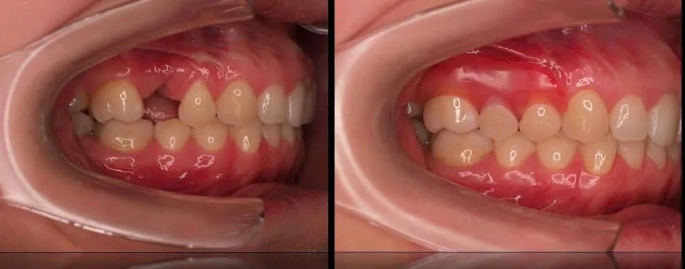 Front teeth partial dentures changed my life