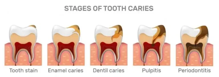 Dangers of Pulling an Abscessed Tooth: What You Must Know in 2026