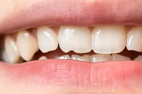How to fix a cracked tooth naturally? 12 Fabulous Tips
