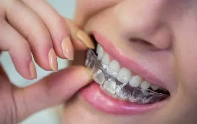 The Real Cost of Invisalign in 2026: My Honest Financial Breakdown