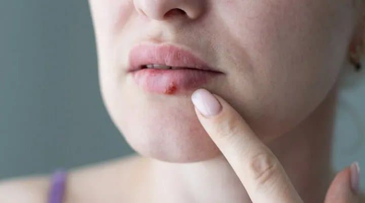How to Get Rid of Cold Sores in 24 Hours: Fast Relief Strategies for 2026