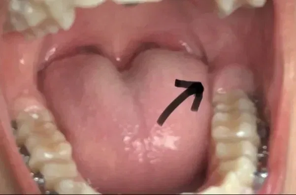 Where Do Wisdom Teeth Grow? Development of the Mouth and Teeth