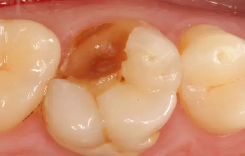 Tooth Broke Off at Gum Line