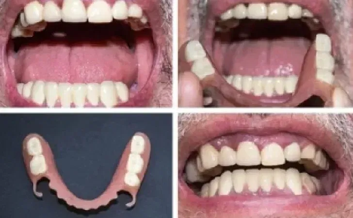 efore and After Partial Dentures Results With Pictures 2026