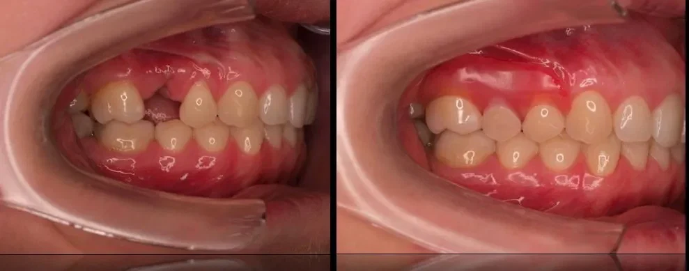 Front teeth partial dentures changed my life