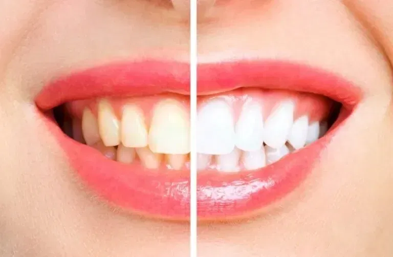 How to Whiten Teeth With Hydrogen Peroxide in 5 Minutes?