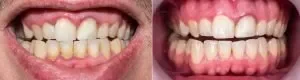 Teeth and puffy inflamed gum before the deep cleaning procedure