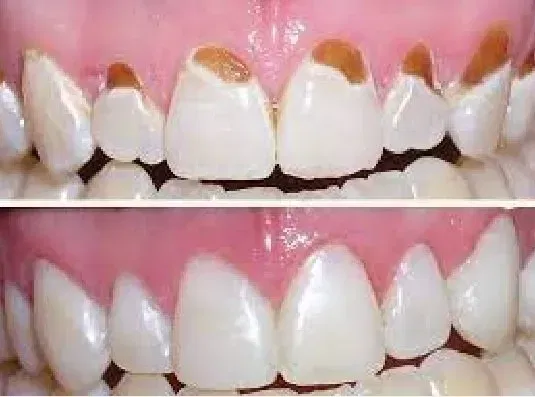 Tooth Decay at Gum Line with Pictures 2023