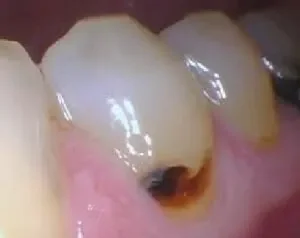 What are the symptoms of a tooth decay at gym line