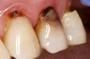 What could possibly cause tooth decay at gum line