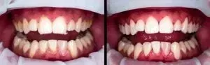 Actual deep cleaning teeth before and after pictures showing healthy pink gums