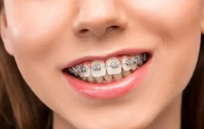 How Long do you Have to Wear Braces? and Why?