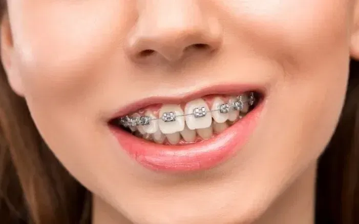 How Much Do Braces Hurt on a Scale 1-10? What to Expect