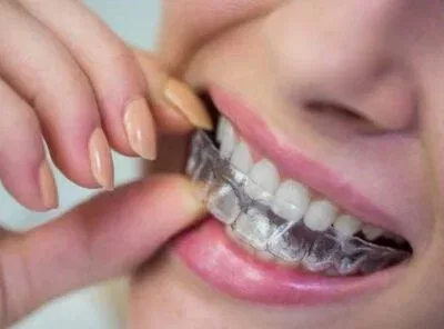 The Real Cost of Invisalign in 2026: My Honest Financial Breakdown