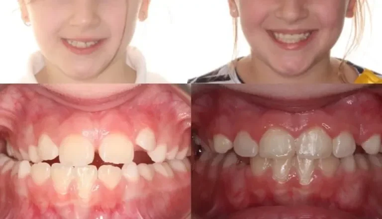 Palate Expander Before and After: With Pictures and What to Expect?