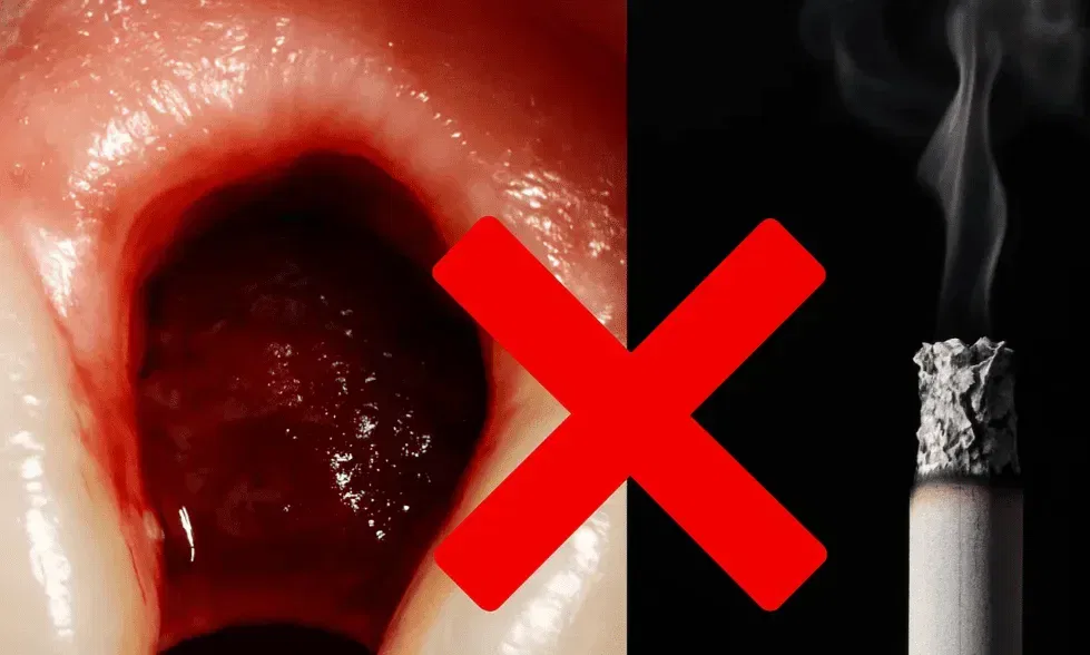 Smoking After Tooth Extraction