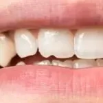 How to fix a cracked tooth naturally?…