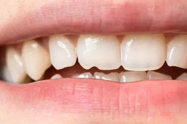 How to fix a cracked tooth naturally? 12 Fabulous Tips