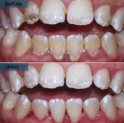 Deep Cleaning Teeth Before and After with (Pictures) is it safe?