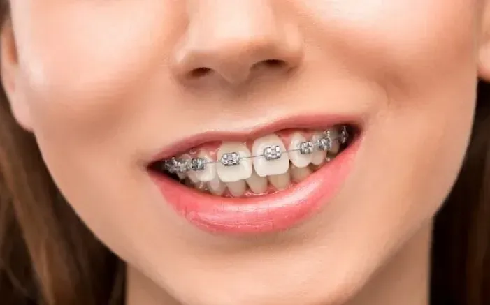 How Much Do Braces Hurt on a Scale 1-10? What to Expect