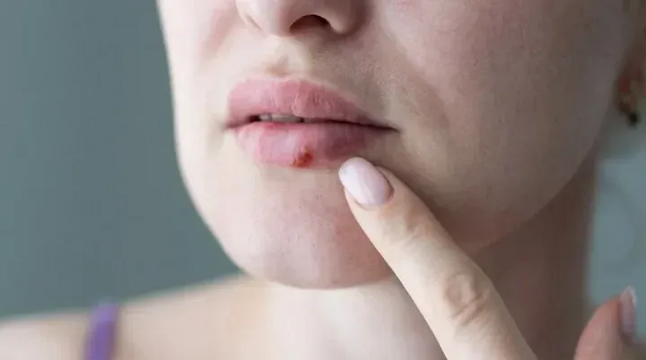 How to get rid of cold sores in 24 hours? Tips from experts
