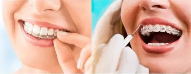 Is Invisalign Cheaper Than Braces? Which Is More Valuable?