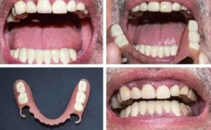 Before and After Partial Dentures Results With Pictures 2026
