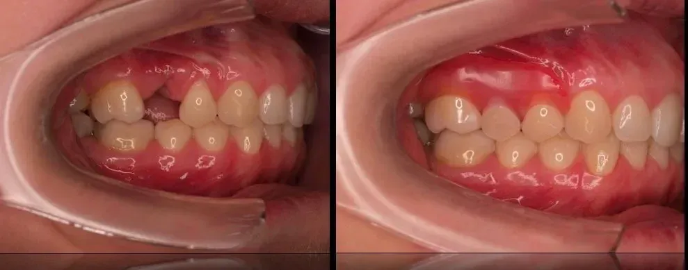 Front teeth partial dentures changed my life