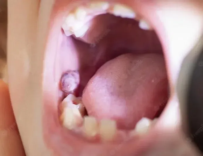 Broken Tooth Root Still in Gum: What to do?