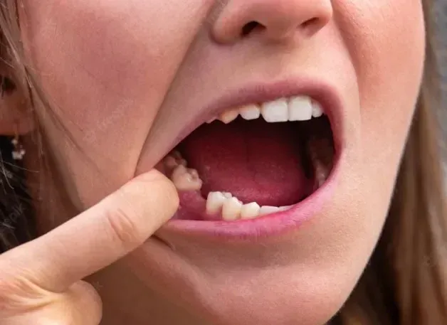I Accidentally Rinsed My Mouth After a Tooth Extraction: What Should You Do
