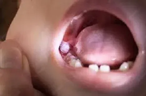 Swollen Gum Behind Back Tooth No Wisdom Teeth: Causes, symptoms, treatments