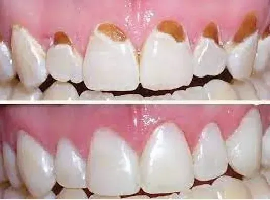 Tooth Decay at Gum Line with Pictures 2023