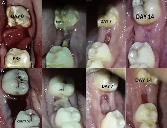 tooth extraction healing pictures day by day stages