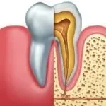 Tooth with Root Canal Hurts with Pressure: Months…