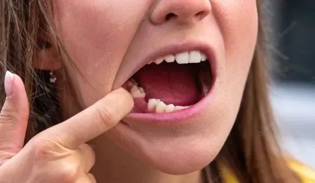 What Should a Tooth Extraction Look Like When Healing With Pictures 2023