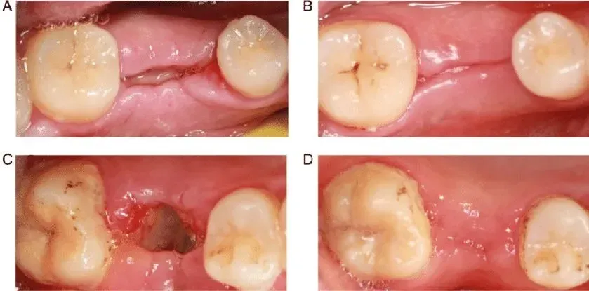 wound healing  process tooth extraction site after 3 days