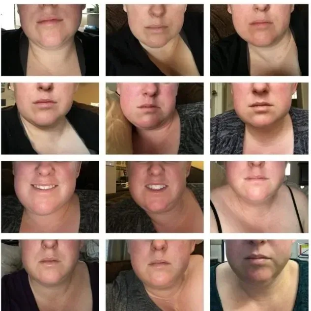 Before And After Wisdom Teeth Removal: 4 Facts You Need to Know