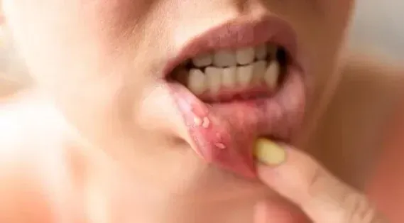 Multiple Canker Sores At Once: Here’s How You Can Get Rid of it in 24H
