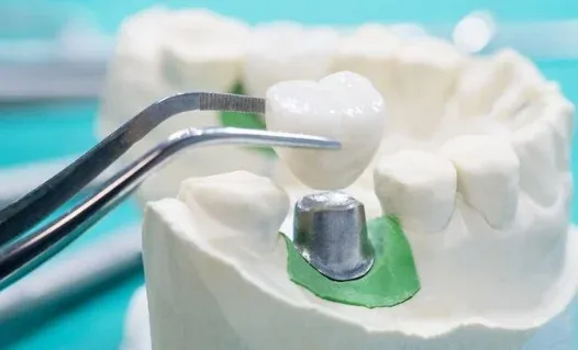 What to Do If Your Crown Falls Out and Doesn’t Hurt