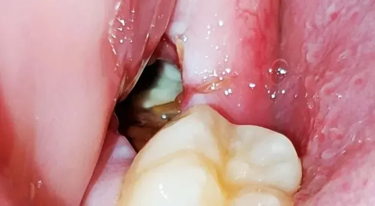 Normal Socket After Tooth Extraction With Pictures 2023