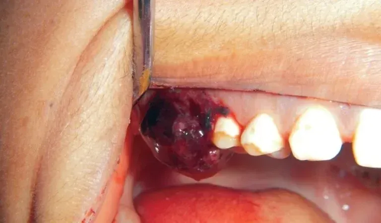 Tooth Extraction Blood Clot Fell Out: Here’s What You Need to Know