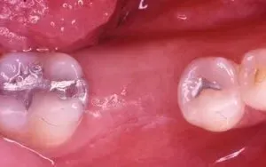 What are the warning signs of dry socket