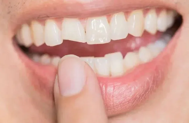 Home Remedy for Broken Tooth with Exposed Nerve: 12 Natural remedies