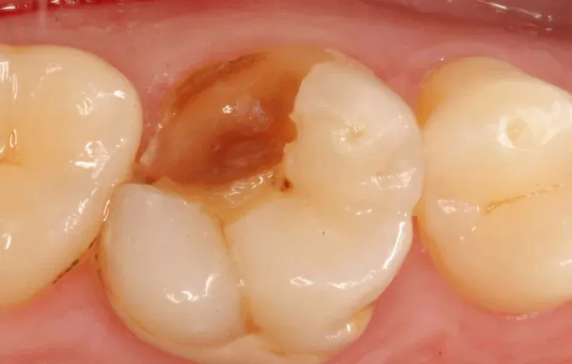 Tooth Broke Off at Gum Line