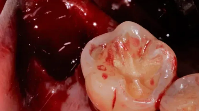 Tooth Extraction Bleeding After 2 Hours: What To Do?