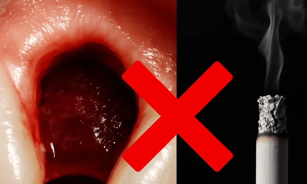 Smoking After Tooth Extraction