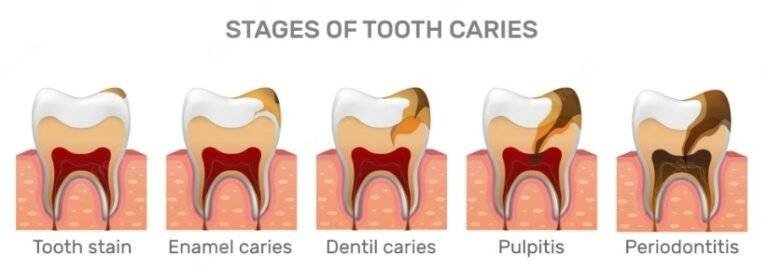 Dangers of Pulling an Abscessed Tooth: What You Must Know in 2026