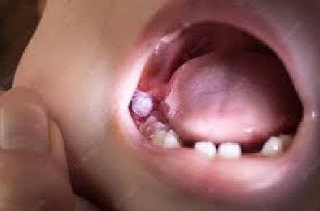Swollen Gum Behind Back Tooth No Wisdom Teeth: Causes, symptoms, treatments
