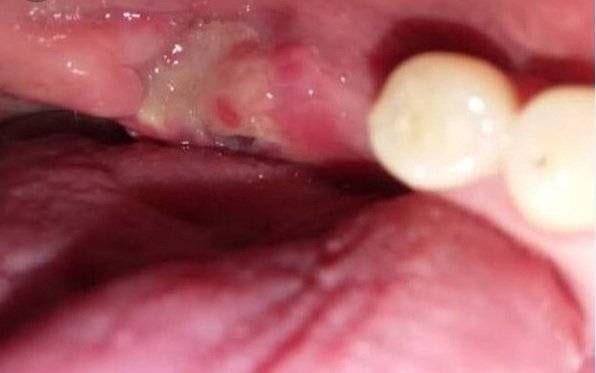 Tooth Extraction Healing White Stuff: What It Is and When to Worry (2026 Guide)