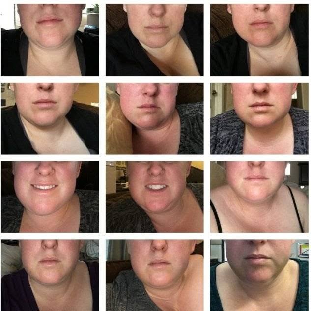 Before and After Wisdom Teeth Removal: 2026 Complete Recovery Guide